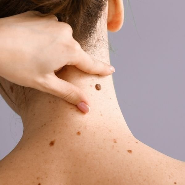 Tratamiento facial con láser